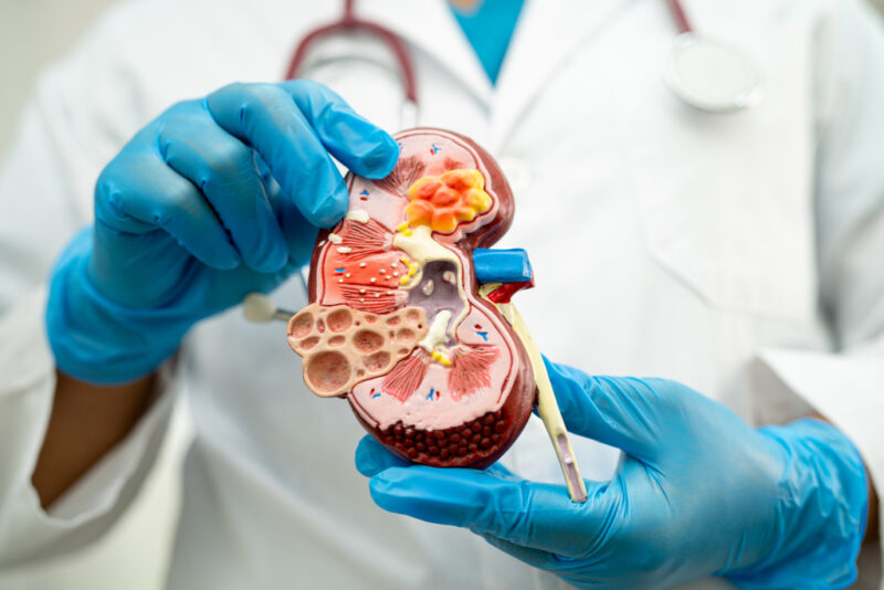 dokter menjelaskan tentang transplantasi ginjal menggunakan model ginjal