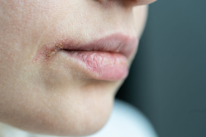 Apa Itu Herpes? Gejala, Penyebab, dan Kapan Harus ke Dokter